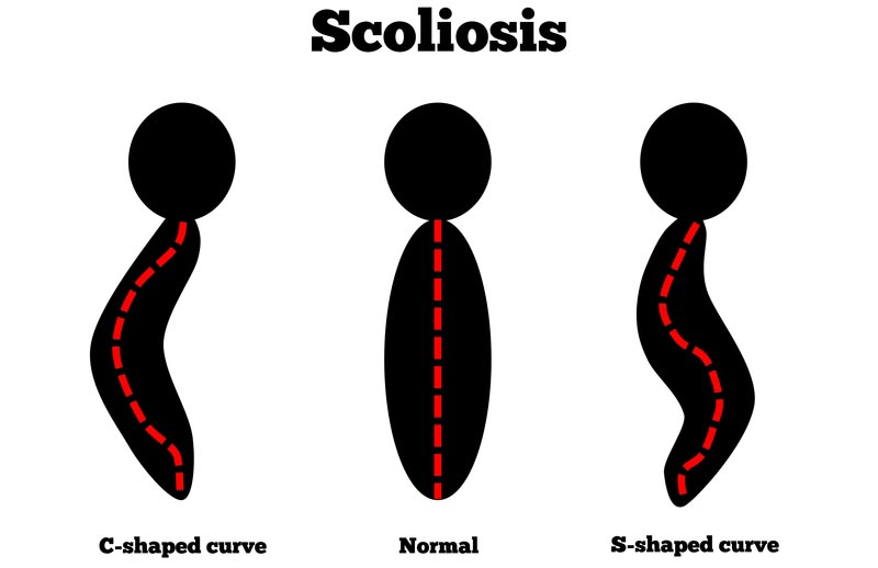 New Orleans, LA scoliosis treatment